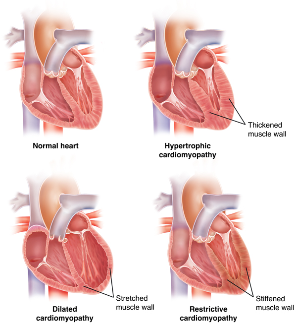 Normal heart beside hearts with hypertrophic, dilated, and restrictive cardiomyopathy, each showing normal, thickened, dilated, and restrictive muscle walls.