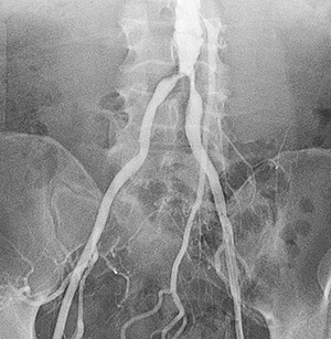 Angiogram of abdominal aorta and iliac arteries.