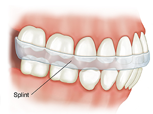 Side view of teeth showing splint.