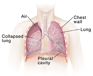 Front view of male chest showing partially collapsed right lung.