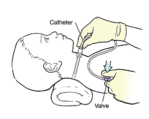 Child lying on back with pillow under neck. Gloved hand holding suction tube in child's tracheostomy. Other hand covering suctioning tube valve with thumb.