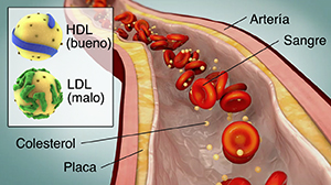Corte transversal de una arteria donde se ven la acumulación de placa y el flujo sanguíneo. En el recuadro, se muestran moléculas de HDL y LDL.