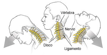 Vista lateral de la cabeza y el cuello de una mujer donde pueden verse las vértebras y los nervios del cuello durante un latigazo.