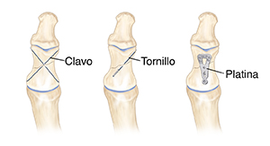 Vista frontal de un hueso fracturado donde pueden verse tres formas de cerrar la fractura: clavos, tornillo y placa.