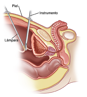 Corte transversal visto de lado de la pelvis de un niño donde pueden verse la vejiga y la uretra. Los instrumentos se insertan en la pelvis a través de la piel. Un instrumento está iluminando el lugar en que otro instrumento está tomando parte del tracto urinario.
