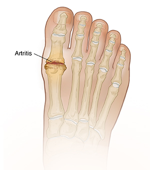 Vista superior del pie donde se observa artritis en la articulación del dedo gordo.