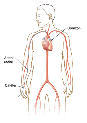 Vista frontal de un hombre donde se observa el catéter insertado en la arteria del brazo y que termina en el corazón.