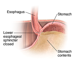 Cross section of top part of stomach, lower esophagus, and diaphragm, showing lower esophageal sphincter closed, keeping stomach contents in stomach.
