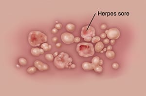 Closeup of herpes sores on skin.
