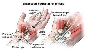 Location of tools and incisions for endoscopic carpal tunnel release surgery.